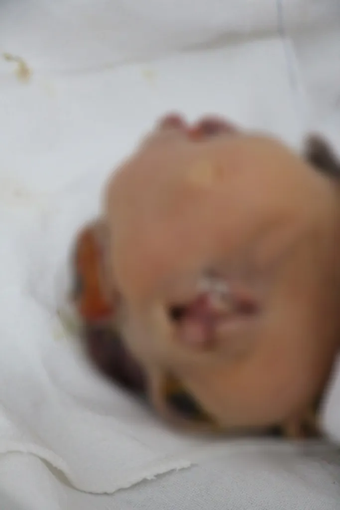 ولادة طفل مشوه في منبج بأربع أعين وفمين اثنين