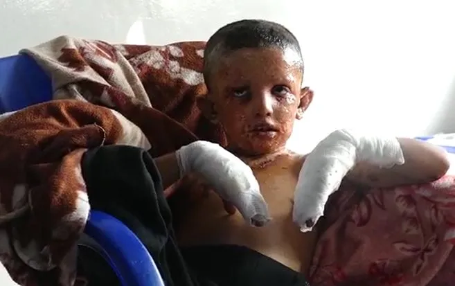 مصابون في مشفى الحسكة: تركيا قصفتنا بالفوسفور