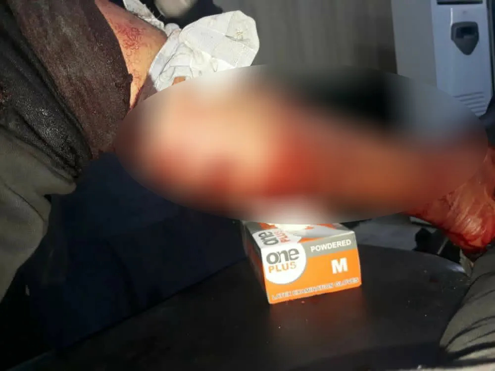 إصابة طفلين جراء استهداف الاحتلال التركي منزلهم في عين عيسى