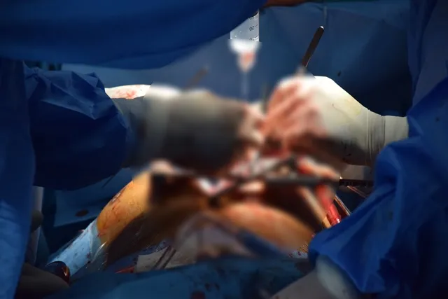 إجراء أوّل عمليّة قلب مفتوح في مشفى العين والقلب بقامشلو