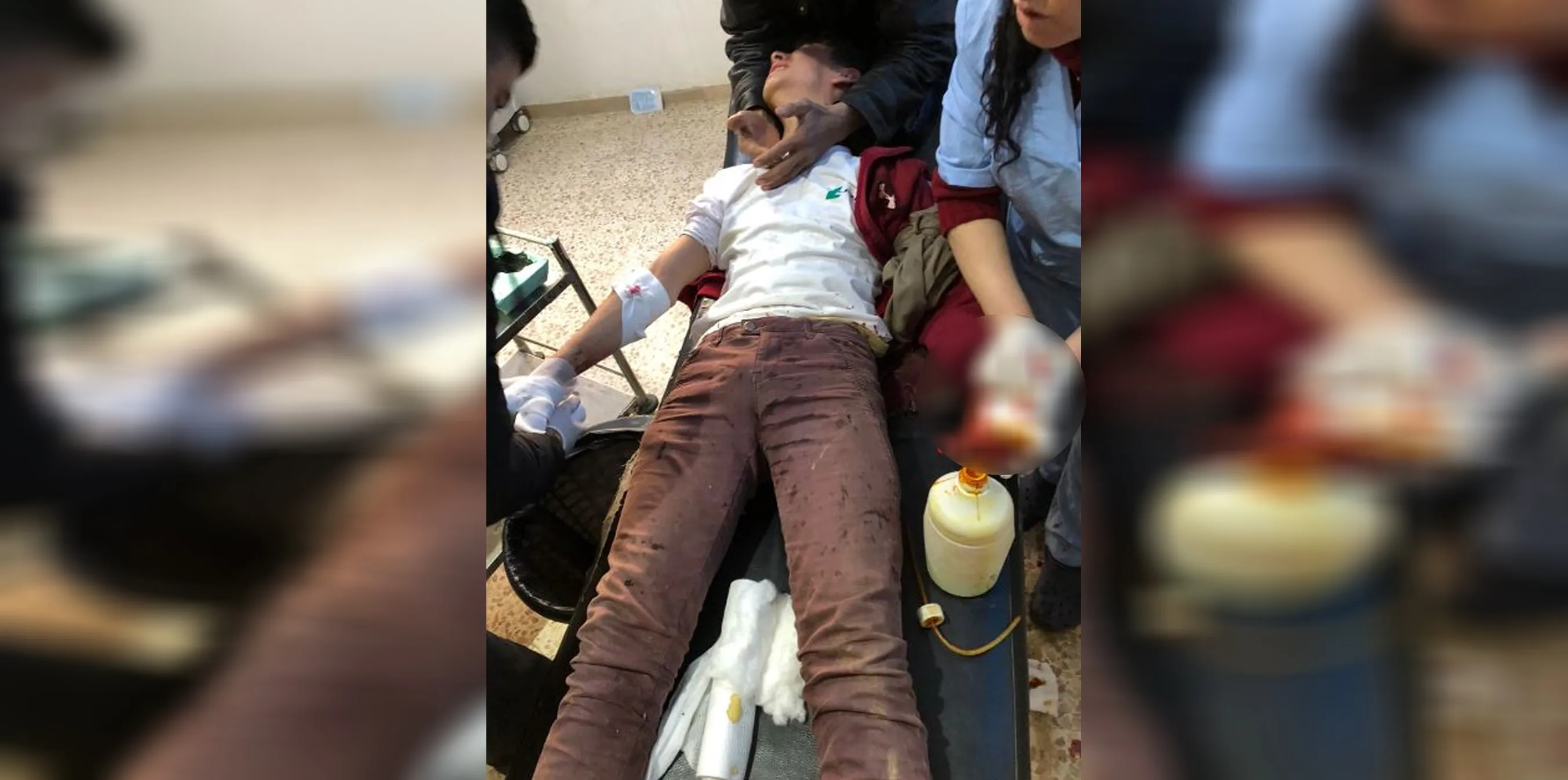 إصابة طفل بريف كري سبي إثر انفجار قنبلة من مخلفات مرتزقة تركيا به