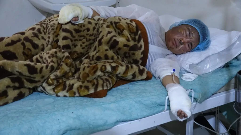 ​​​​​​​حالة المصابين جراء احتراق خيمة صفية بمخيم مهجري كري سبي يوم أمس