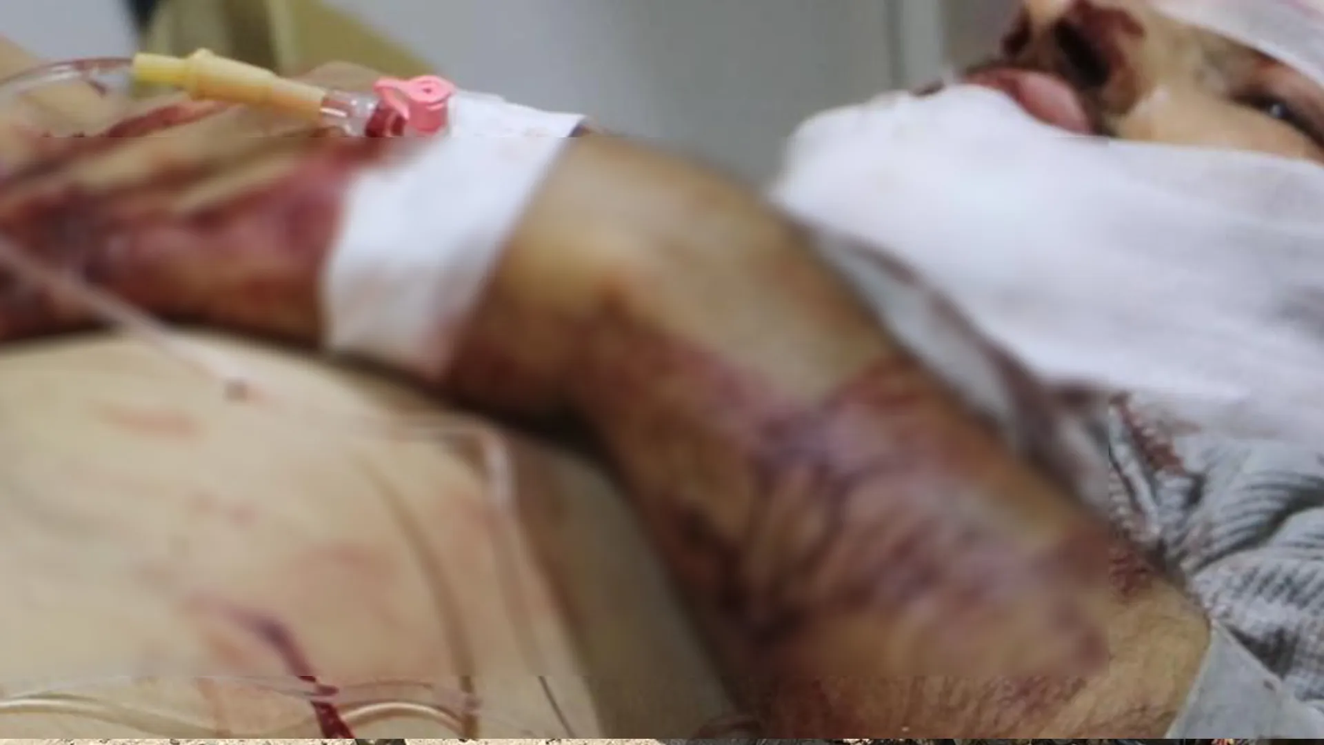 ​​​​​​​3 جرحى في قصف مسيّرة تركية في كوباني