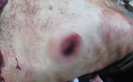 إصابة مواطنيْنِ في قصف للاحتلال التركي على الشهباء
