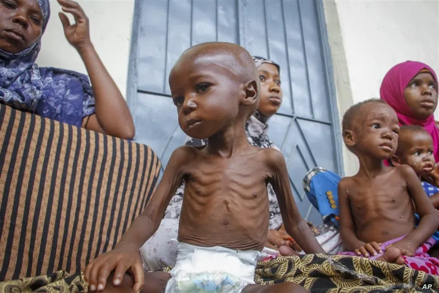 60 ألف طفل يعانون سوء التغذية في جنوب السودان