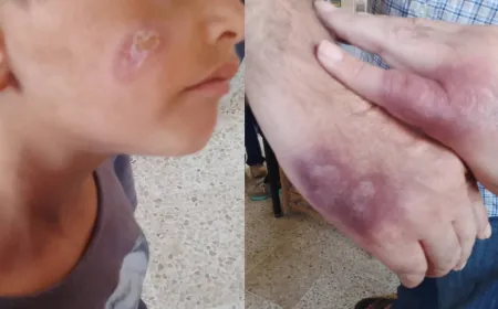 غياب العيادة يدفع الأهالي إلى التداوي الشعبي من الليشمانيا وسط مطالب بتدخل عاجل