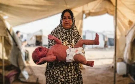 جدري الماء يهدد النازحين في غزة