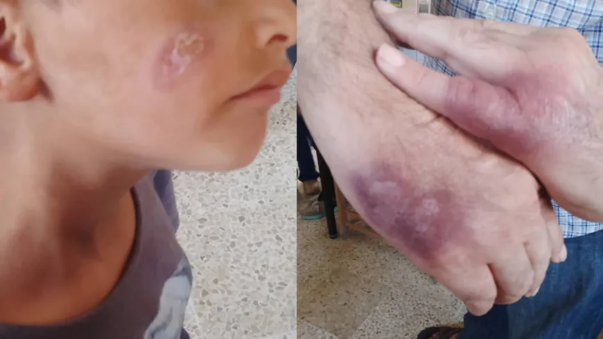 غياب العيادة يدفع الأهالي إلى التداوي الشعبي من الليشمانيا وسط مطالب بتدخل عاجل