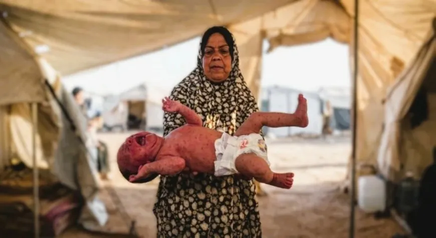 جدري الماء يهدد النازحين في غزة