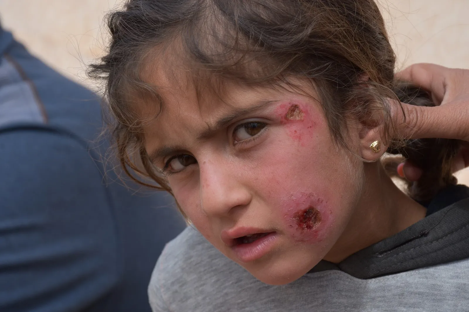 leishmaniasis threatens lives of thousands of civilians in al-Shahba
