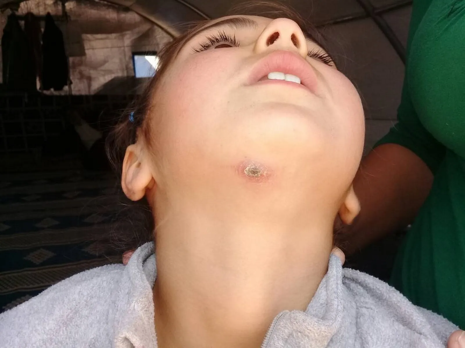 leishmaniasis threatens lives of thousands of civilians in al-Shahba