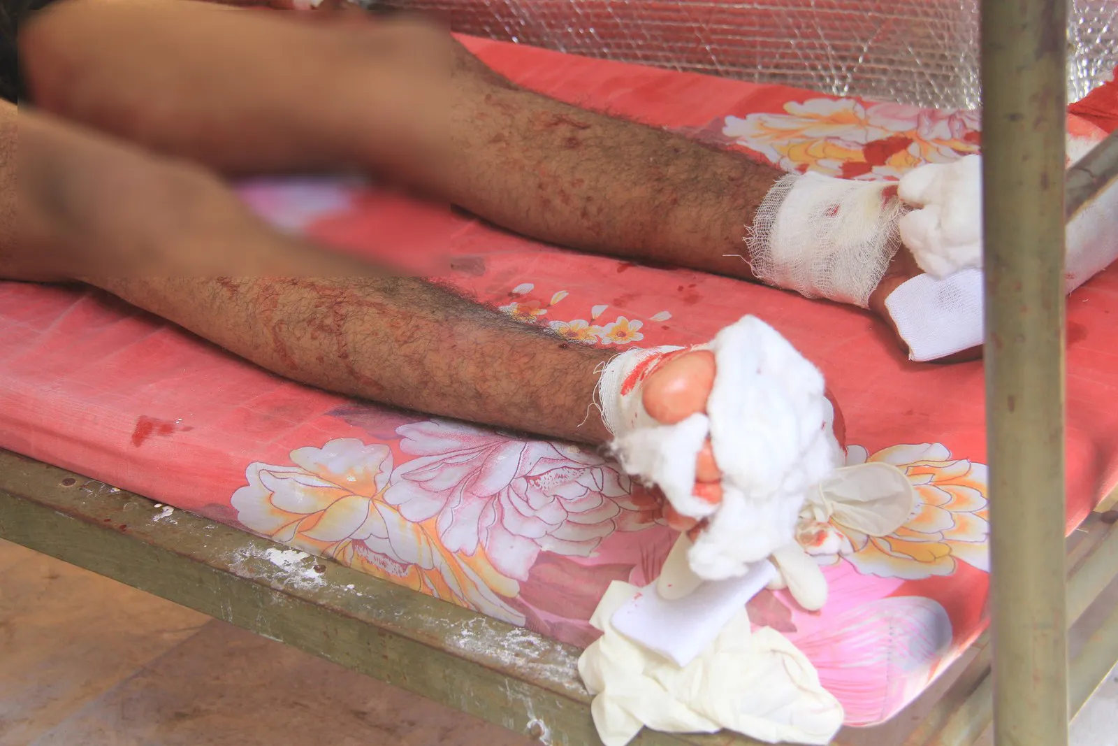 Mine blasted in al-Shahba, 1 Afrin child wounded
