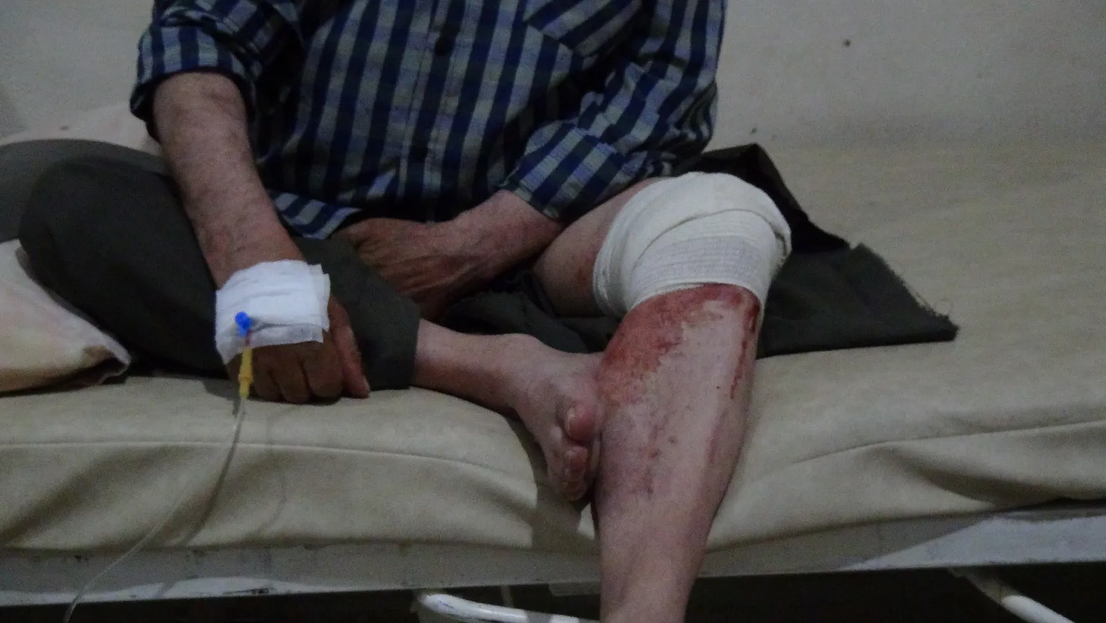 Turkish bombardment's wounded: We to continue our struggle till Afrin liberation