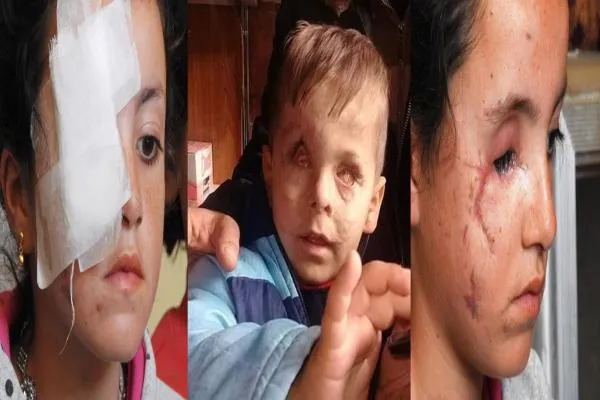 Turkish aggression on Afrin caused permanent disabilities to 102 child 