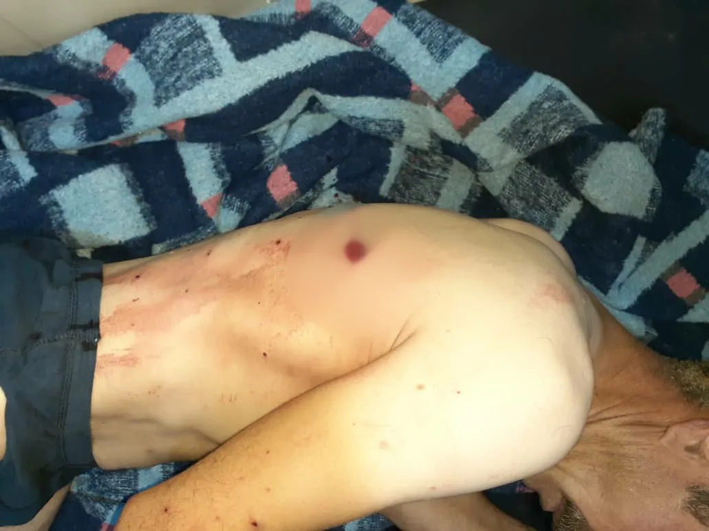 Explosive mine explosion in al-Shahba injures a citizen