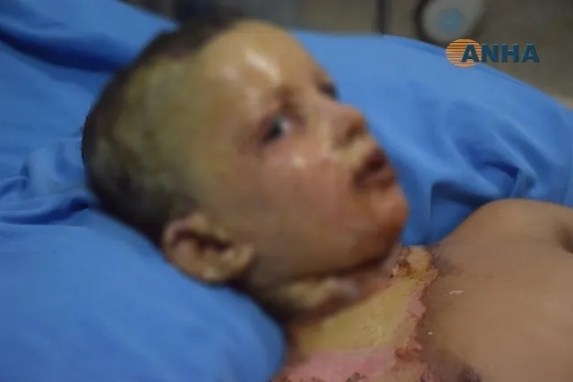 A doctor at al-Hasakah hospital believes that occupation army used prohibited weapons