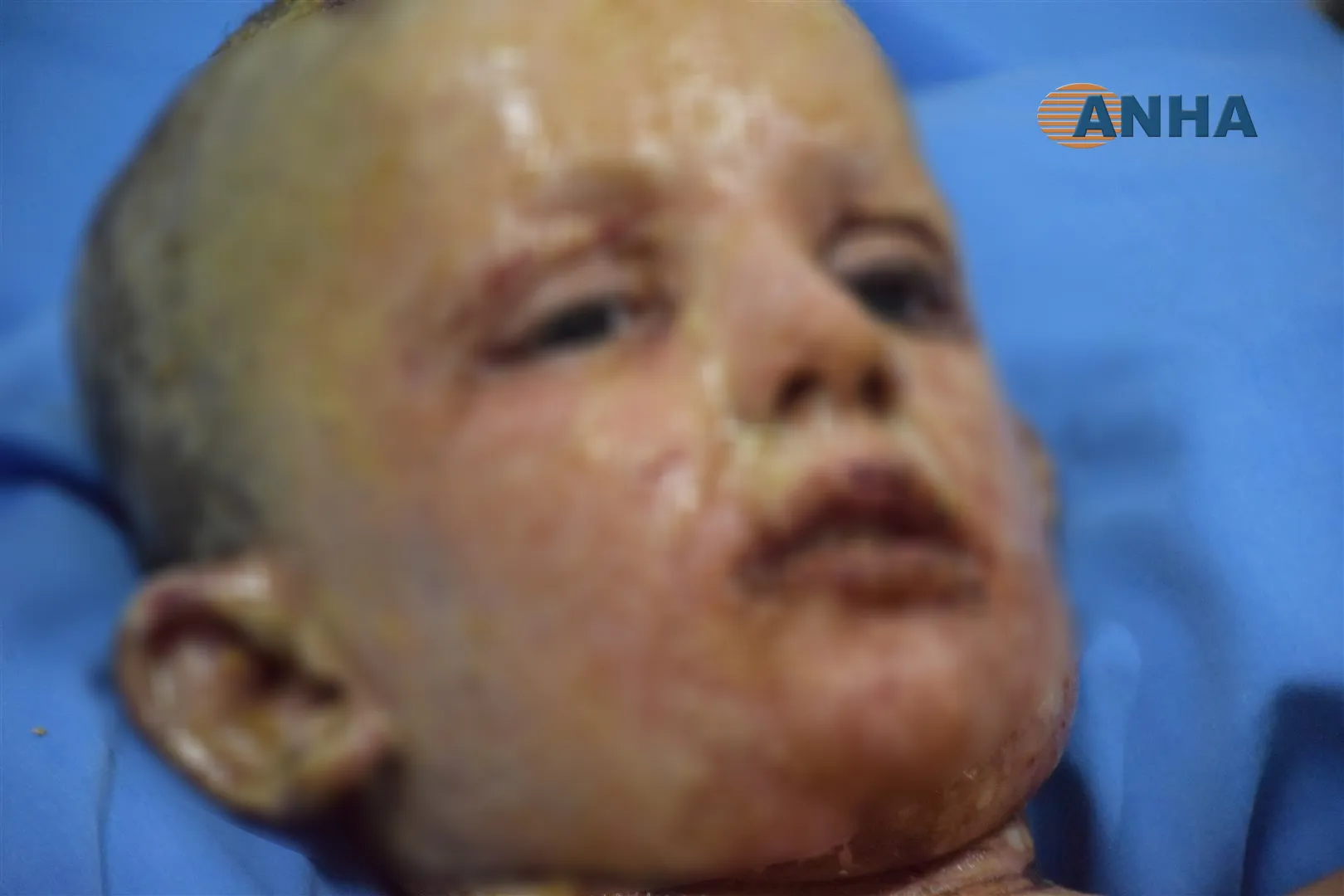 A doctor at al-Hasakah hospital believes that occupation army used prohibited weapons