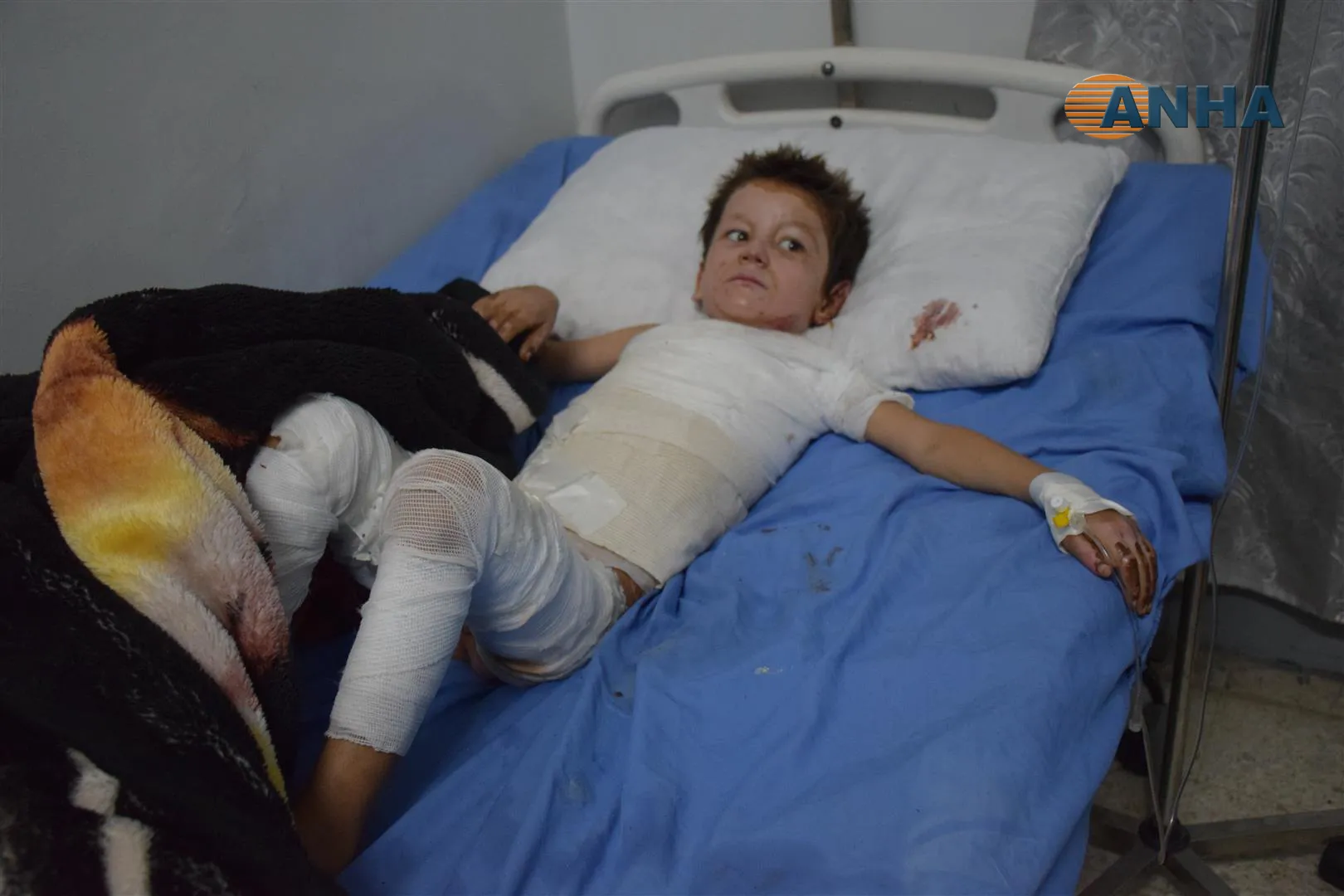 A doctor at al-Hasakah hospital believes that occupation army used prohibited weapons