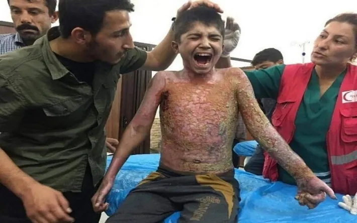 Though he escaped ISIS, Mohammed was burnt by Turkish occupation’s phosphorus