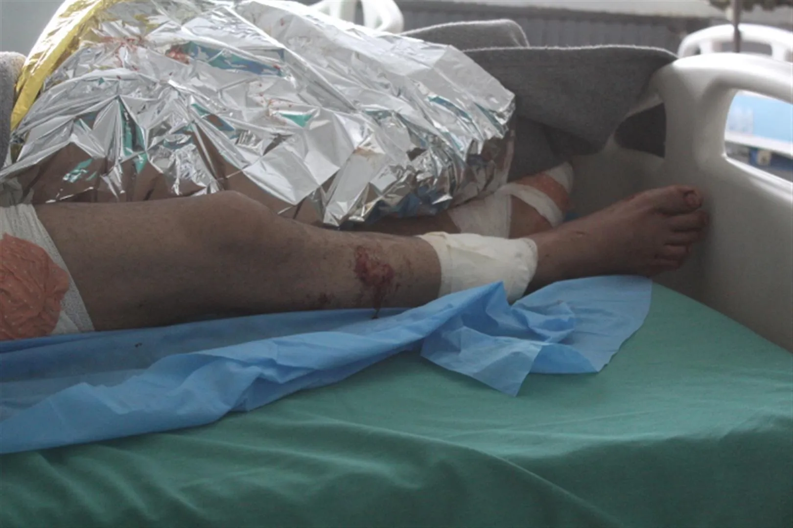 Civilian injured in Turkish shelling on Um al-Keif village