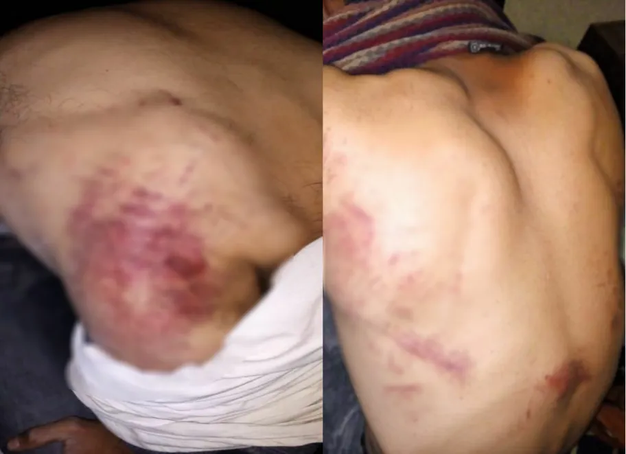 ​​​​​​​2 young men from Kobane severely beaten by Turkish occupation soldiers