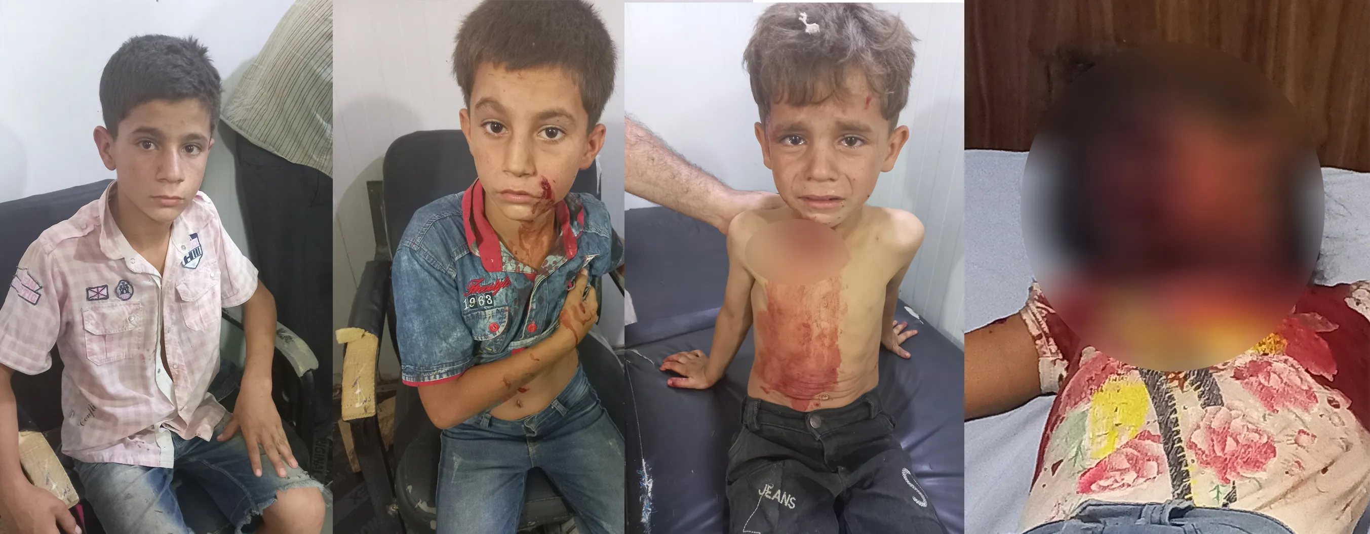 4 children injured in a mine explosion left by mercenaries in Al-Shahba