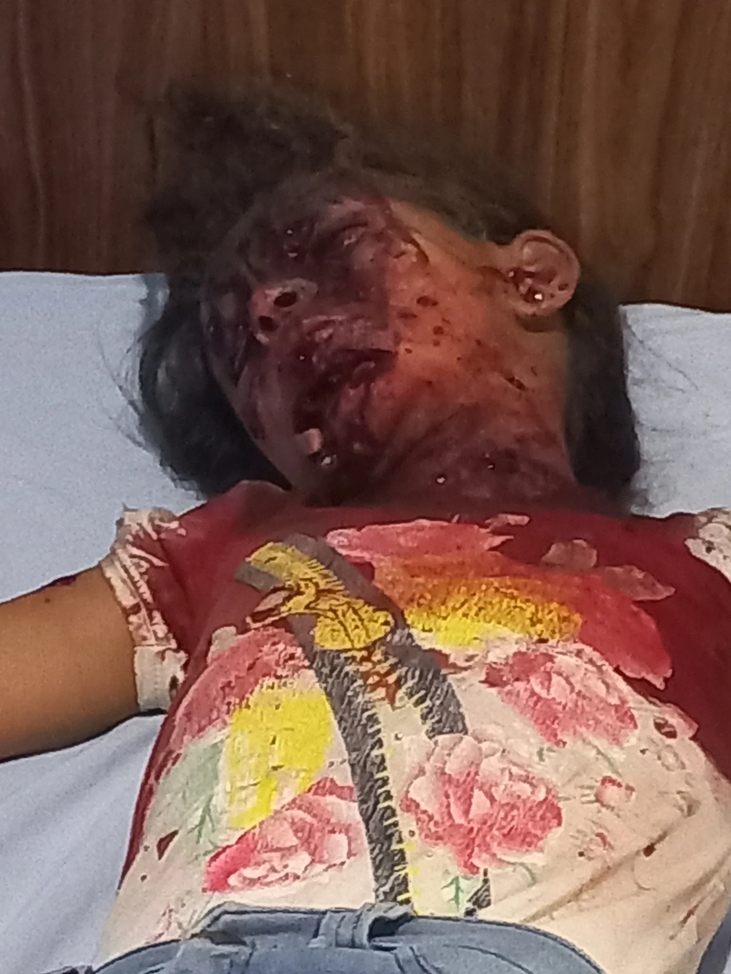 4 children injured in a mine explosion left by mercenaries in Al-Shahba