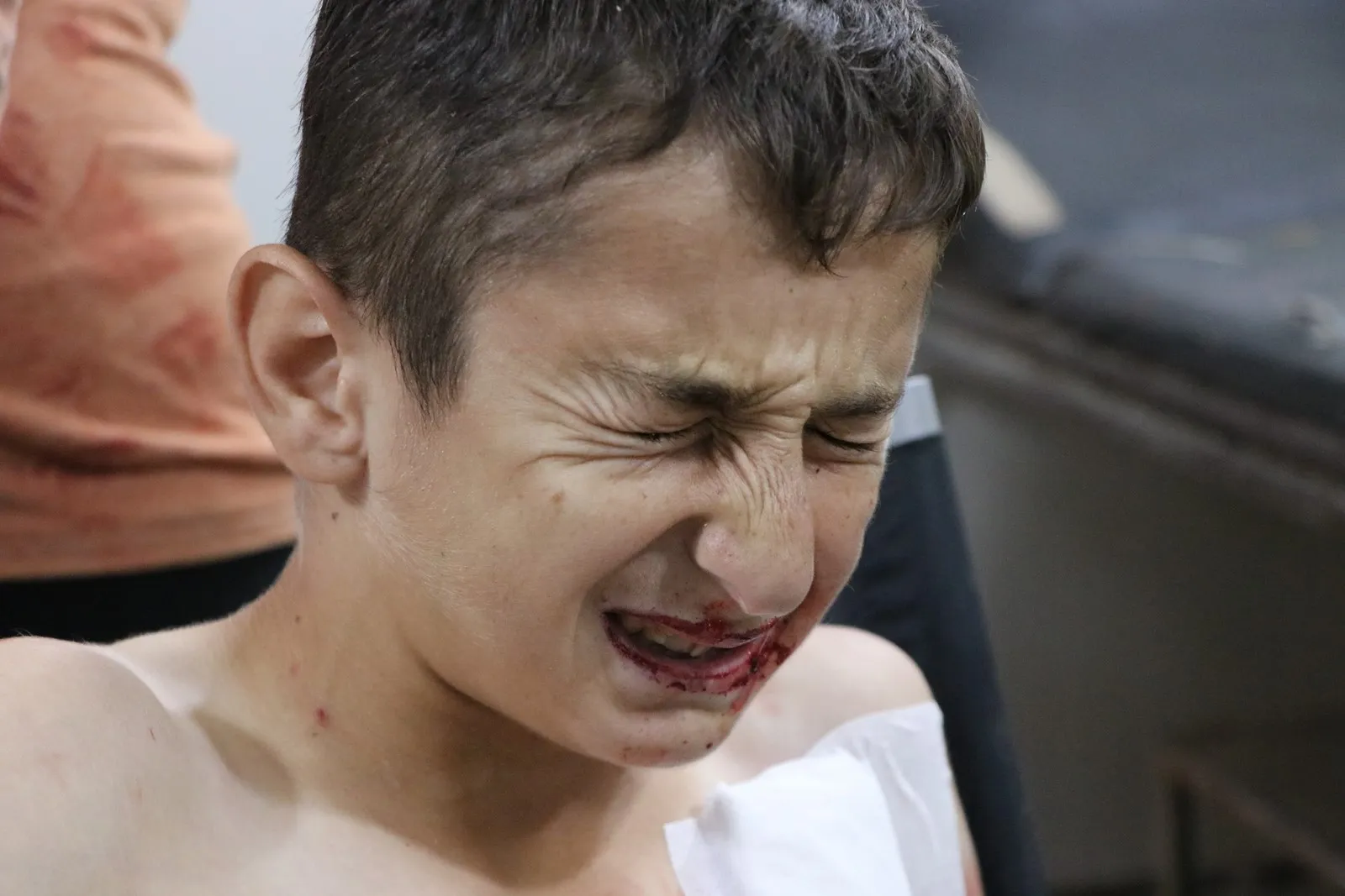 Four IDPs children injured in mine explosion
