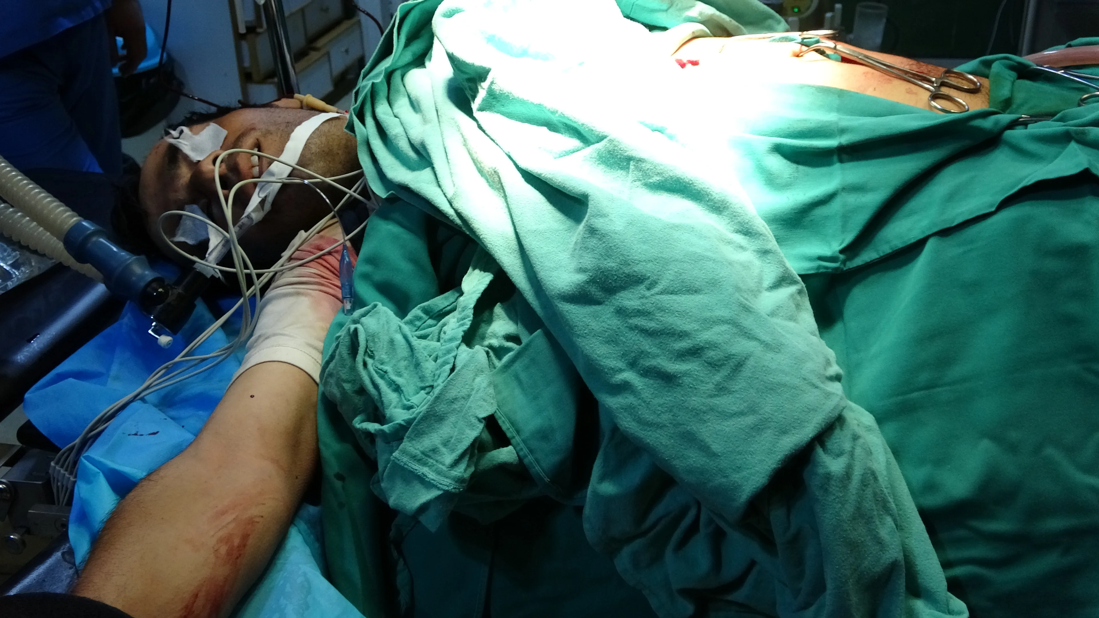 Citizen seriously injured by Turkish fire in eastern Qamishlo