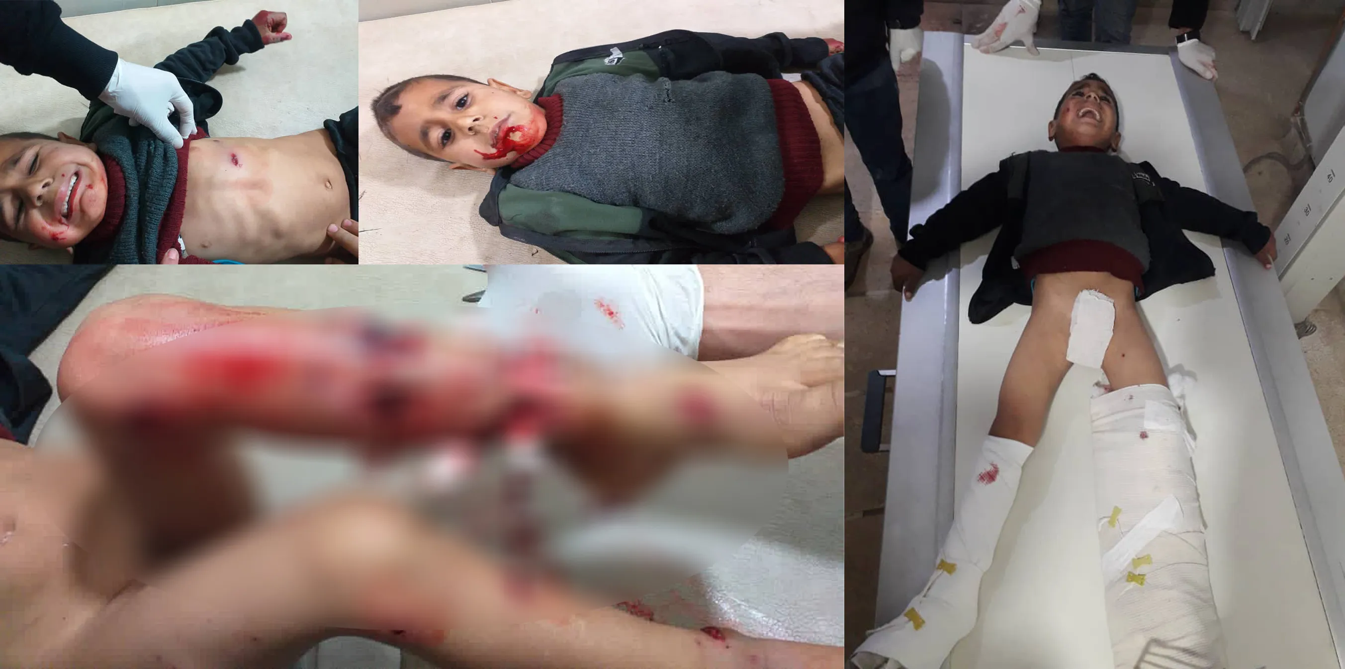 Child injured after the ISIS remnant mine exploded in Shahba canton