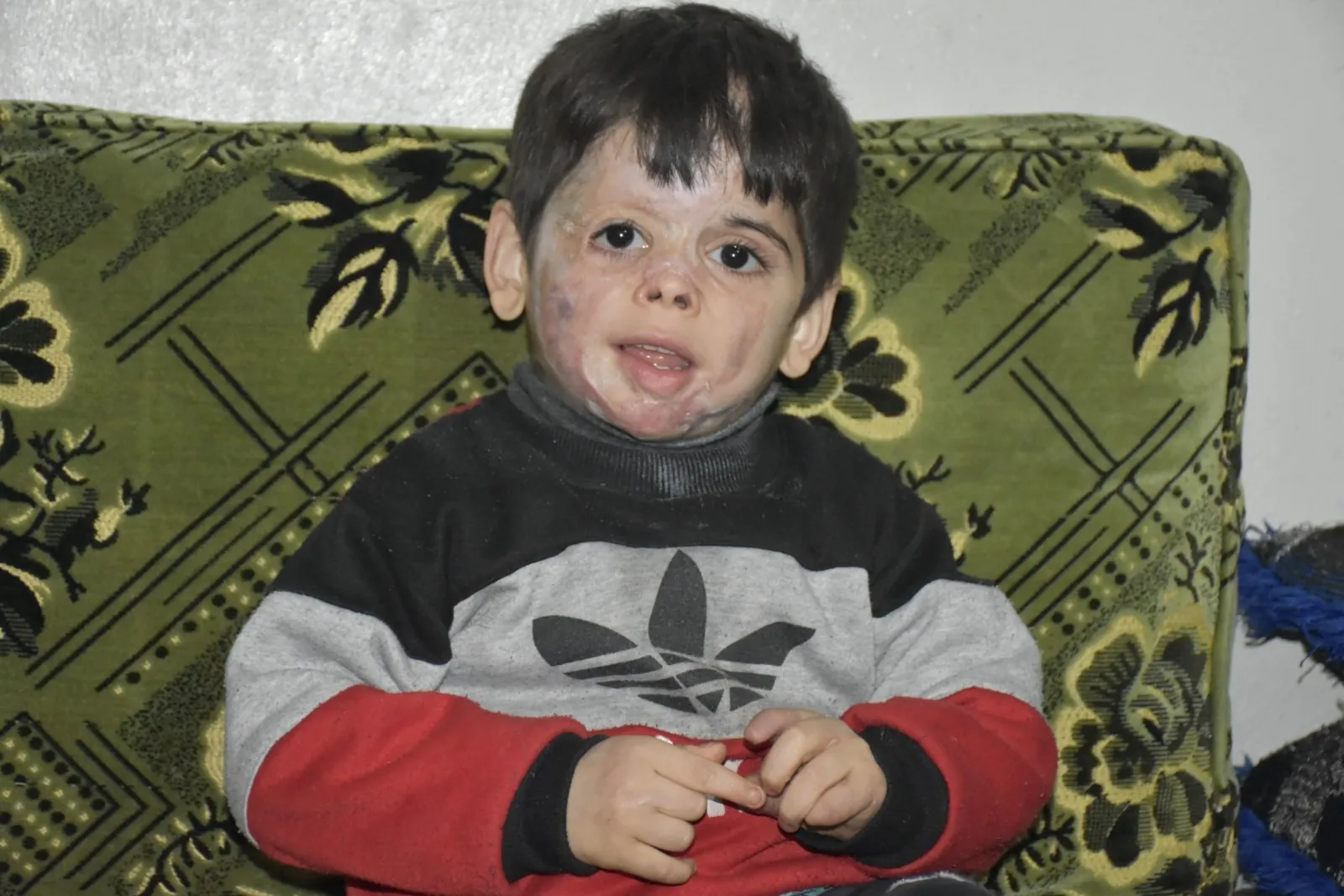 Los crímenes de la ocupación turca se muestran en rostros y cuerpos de niños de Afrin
