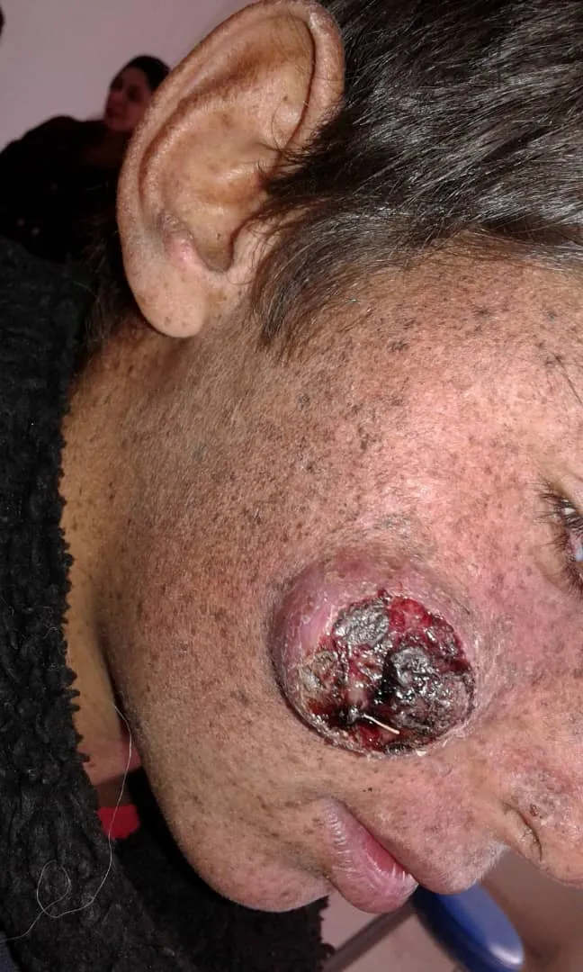Dermanê Laşmaniya ji Kobanê re hate peydakirin