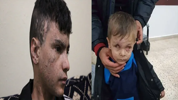 Kongreya Star wê her du zarokên Tirkiyê birîndar kirî, derman bike