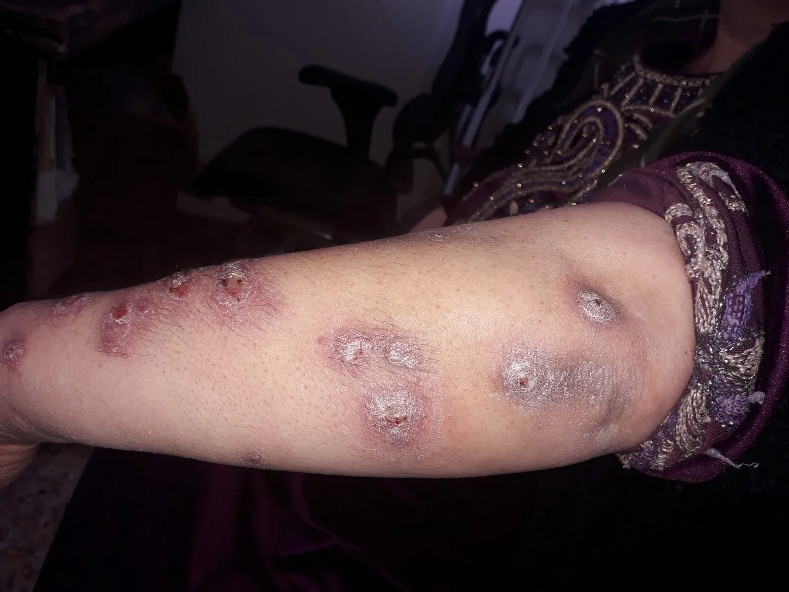 Heyva Sor ji bo pêşîlêgirtina nexweşiya laşmanya bang kir