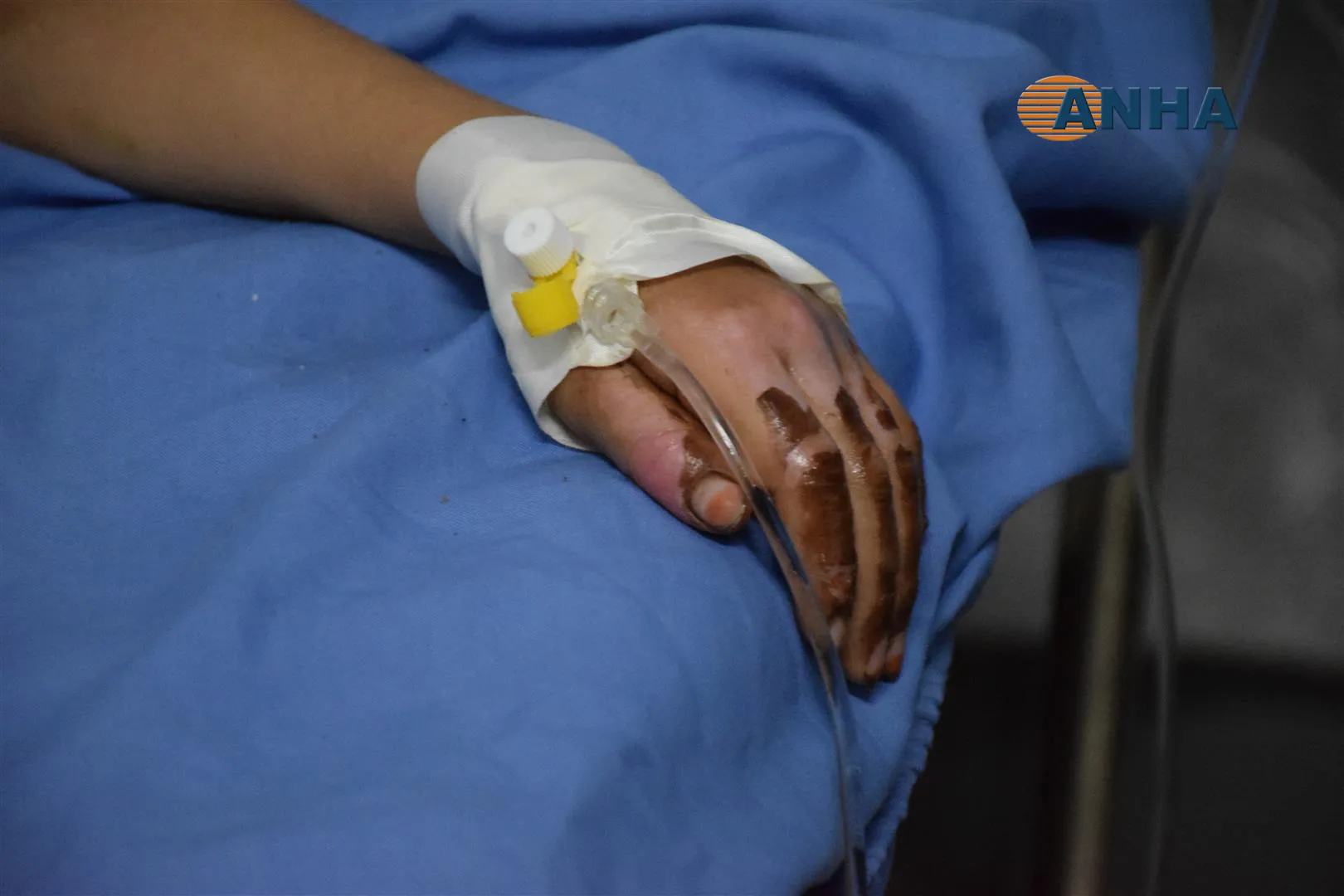 Bijîşkekî Nexweşxaneya Hesekê texmîn dike ku artêşa dagirker çekên qedexekirî bikar aniye