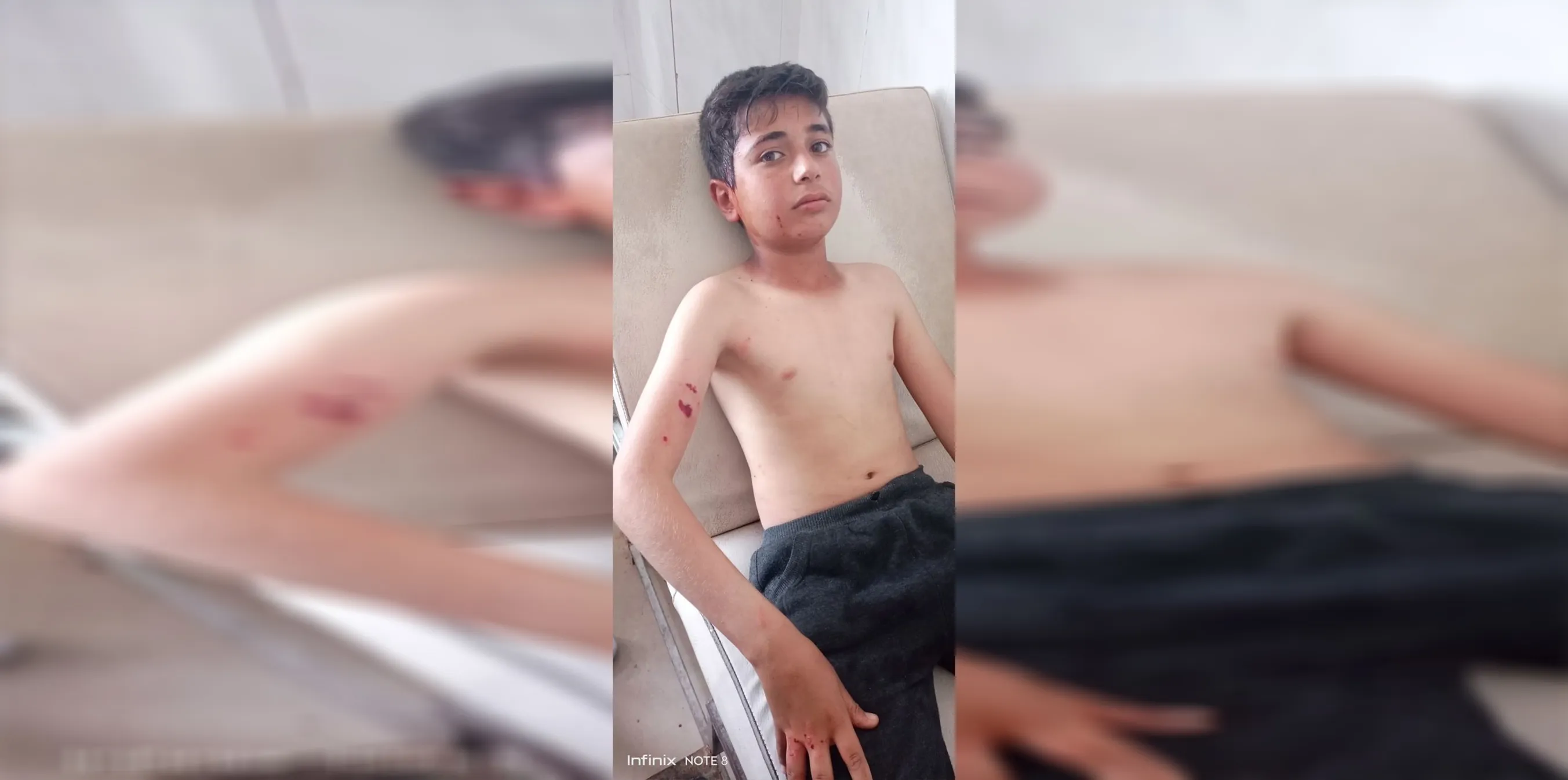 Di topbarana li ser gundê Bênê de zarokek birîndar bû