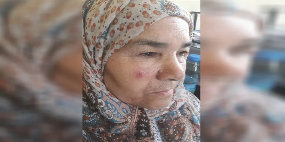 Лейшманиоз распространился в Кобани